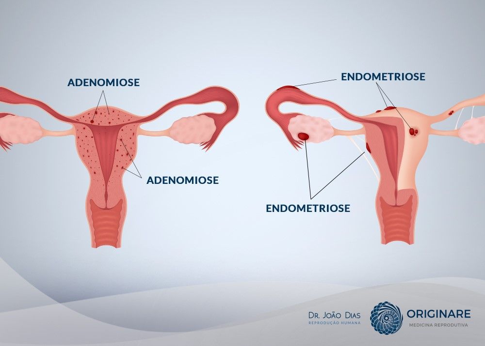 Adenomiose vs. Endometriose: Entenda as Diferenças e Semelhanças