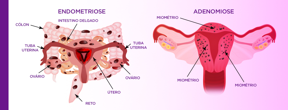 DIU Hormonal para Adenomiose: Uma Opção de Tratamento Eficaz?