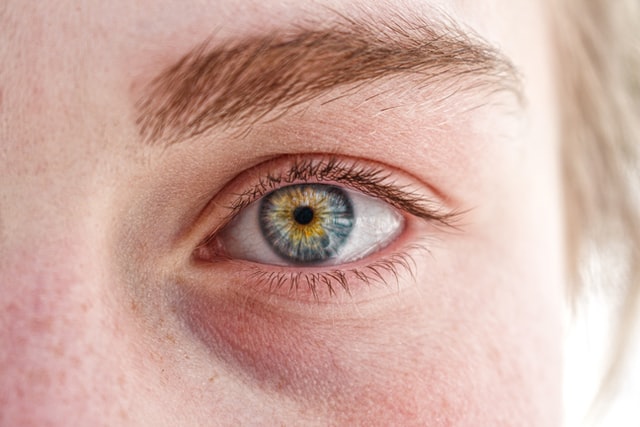 Guia Completo: Descubra Seu Tipo de Olheira e o Tratamento Ideal