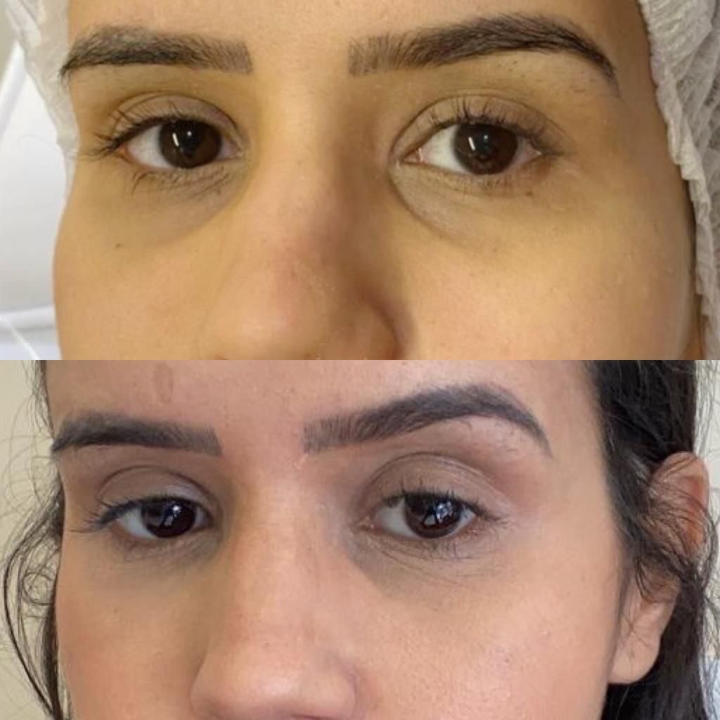 Rinite e Olheiras: Entenda a Conexão e Como Minimizar os Efeitos