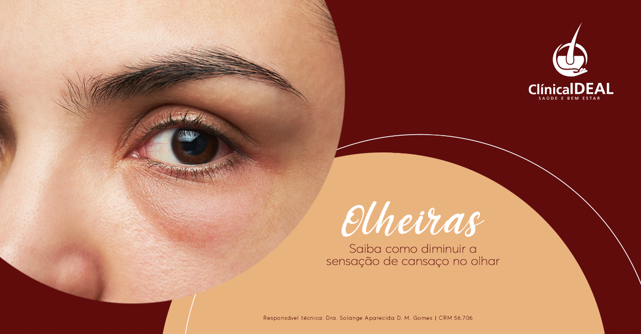 Procedimentos Estéticos para Olheiras: Qual o Mais Indicado para Você?