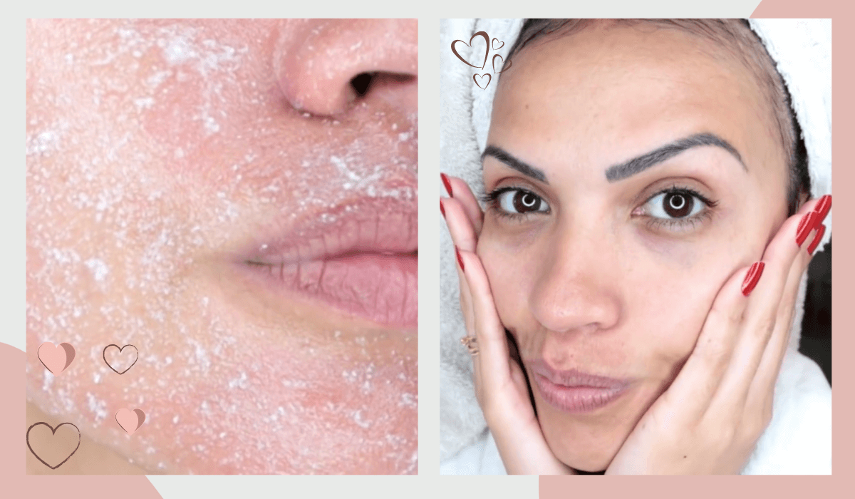 receita de peeling natural para acne