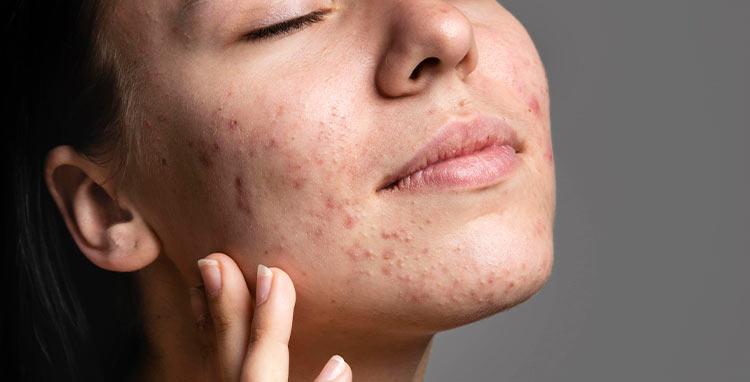 Guia Completo dos Ativos para Acne: Qual o Melhor para Você?
