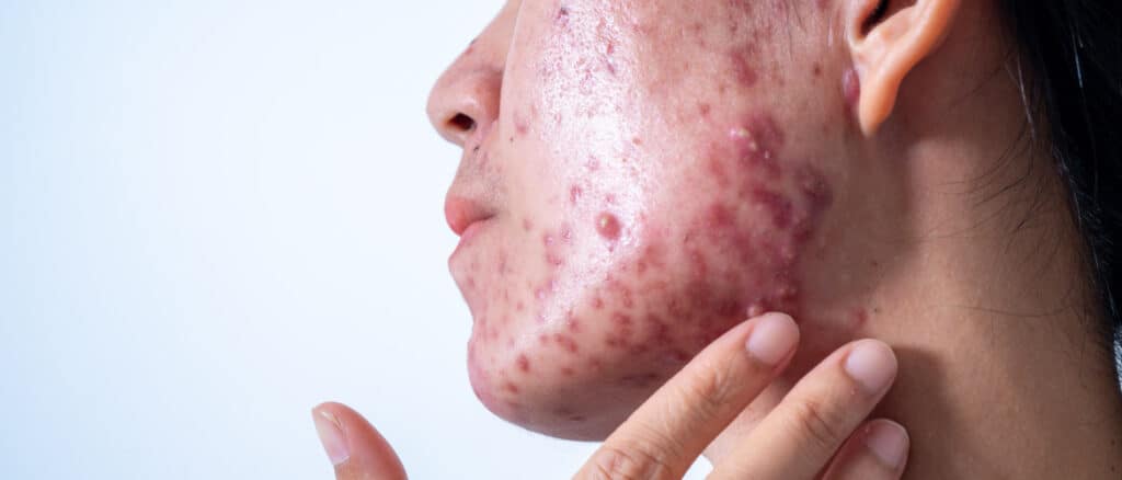 Acne Hormonal: Causas