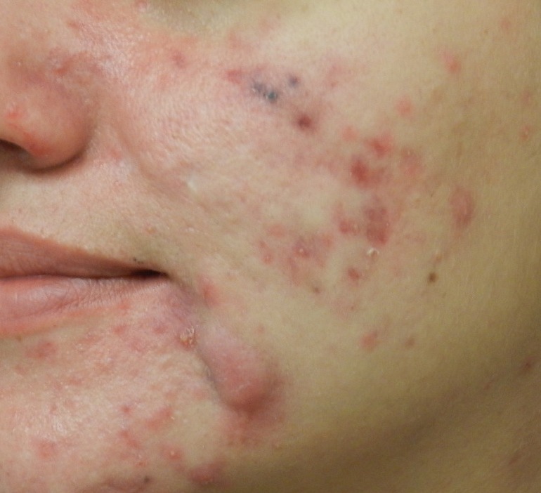Mitos e Verdades sobre a Acne: O Que Realmente Funciona?