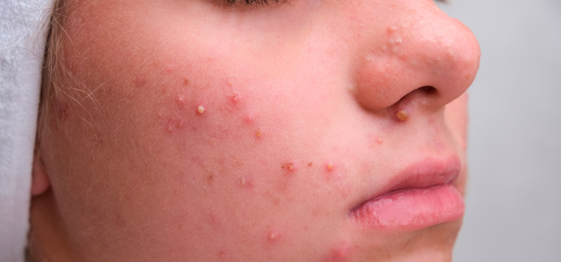 Prevenindo Cicatrizes de Acne: Dicas Essenciais Pós-Tratamento
