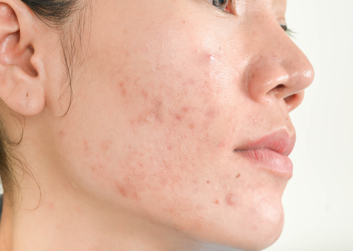 Guia Completo dos Ativos para Acne: Qual o Melhor para Você?