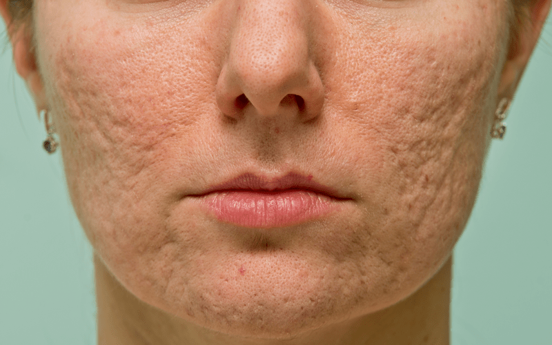 Acne Hormonal: Causas