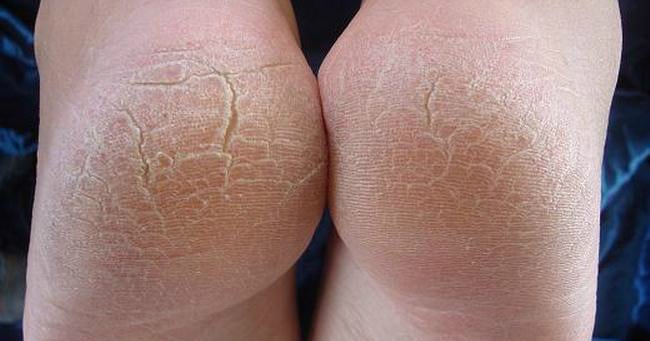 Como Prevenir Rachaduras nos Pés: Hábitos e Cuidados Essenciais