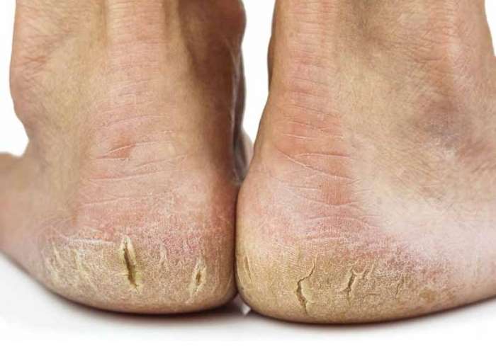 Como Prevenir Rachaduras nos Pés: Hábitos e Cuidados Essenciais