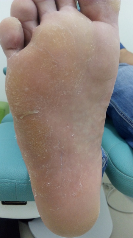 Os Melhores Cremes com Ureia para Pés Rachados: Guia Completo