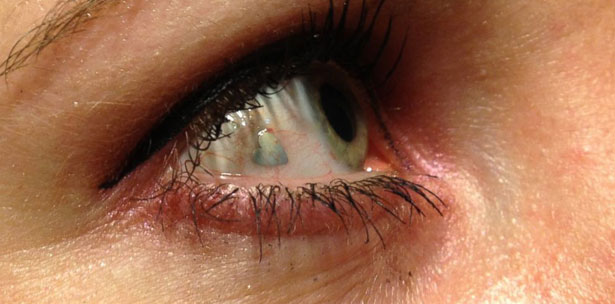 Microdermal vs. Piercing Tradicional: Qual a Melhor Opção?