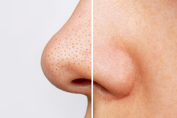 skincare para poros