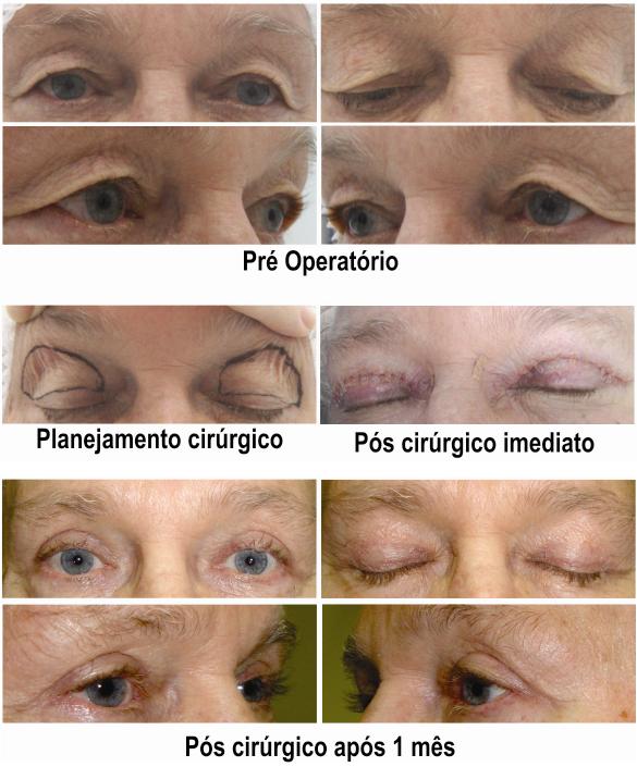 preparação de pálpebra