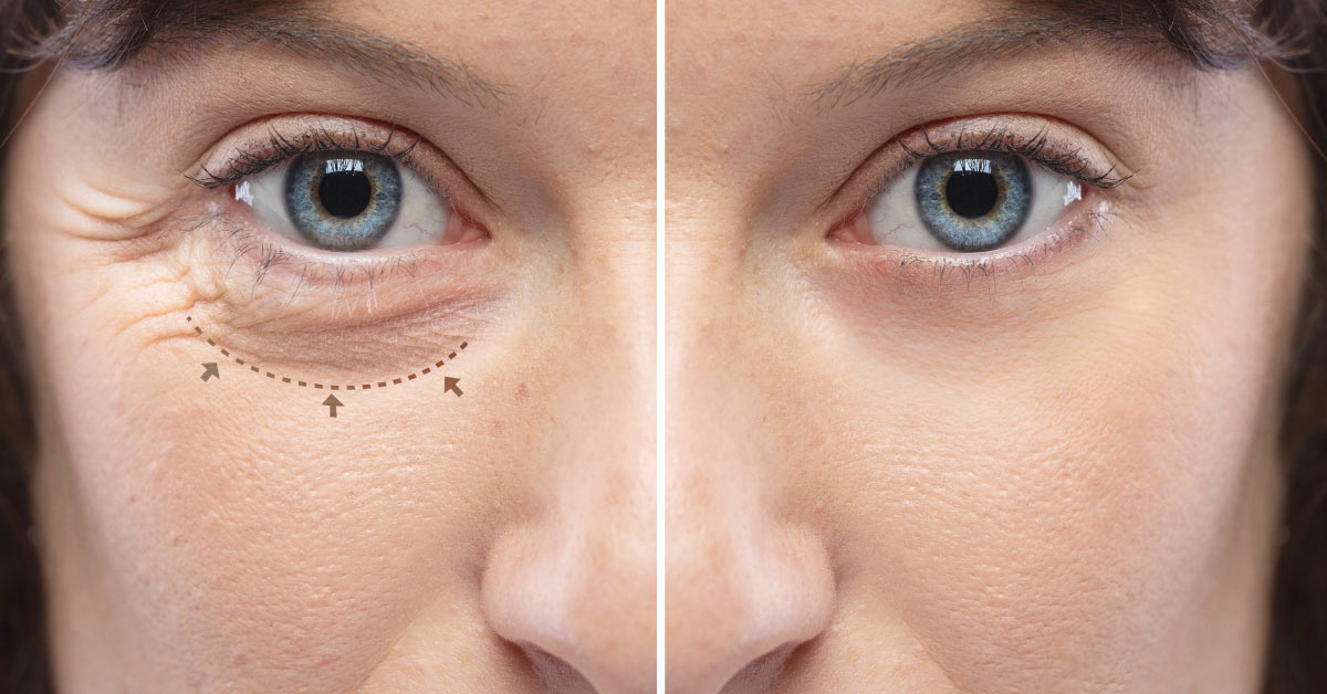 preparação de pálpebra