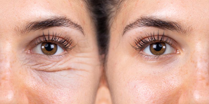 preparação de pálpebra