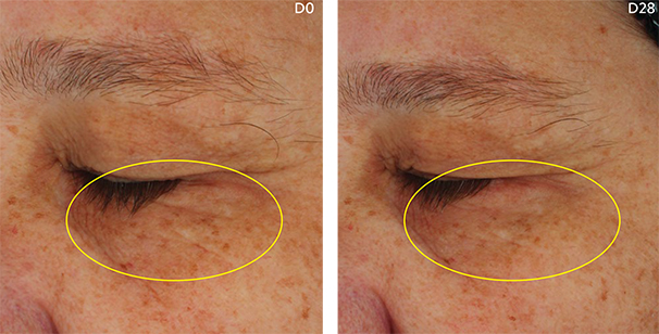 retinol e área dos olhos