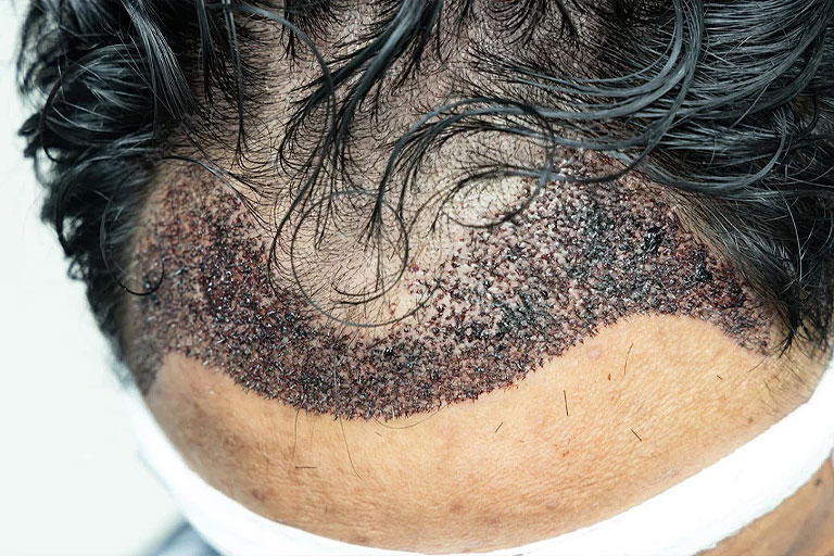 Como identificar o Scab Hair em casa