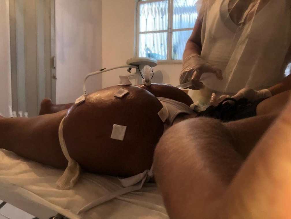 Alternativas à Gluteoplastia: Bioestimuladores e Outros Métodos para Aumentar o Bumbum sem Cirurgia