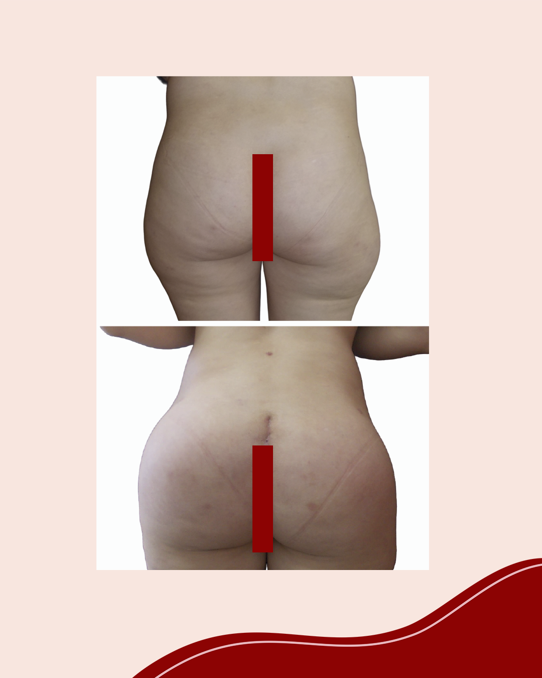 Marcas de Prótese de Glúteo: Qual a Melhor Escolha para um Resultado Natural e Seguro?