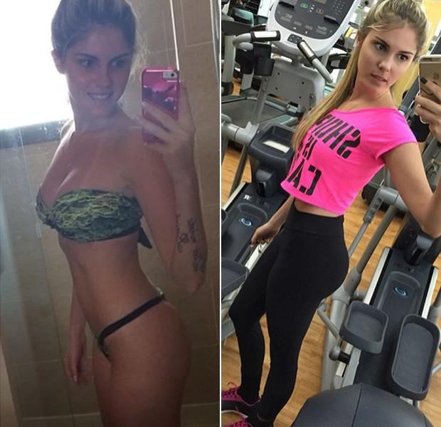 Marcas de Prótese de Glúteo: Qual a Melhor Escolha para um Resultado Natural e Seguro?