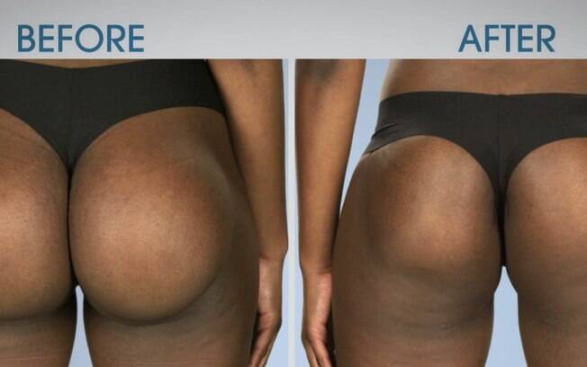 Pós-Operatório da Gluteoplastia: Guia Completo para uma Recuperação Tranquila