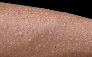 Toxina botulínica para hiperidrose: Como funciona e resultados esperados