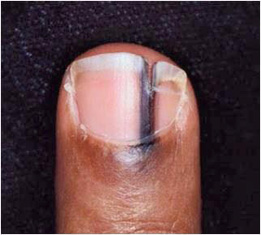 Deficiências Nutricionais e Suas Manifestações nas Unhas: Um Guia Detalhado