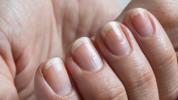 Melanoníquia: Entenda as Listras Escuras nas Unhas e Quando Procurar Ajuda Médica