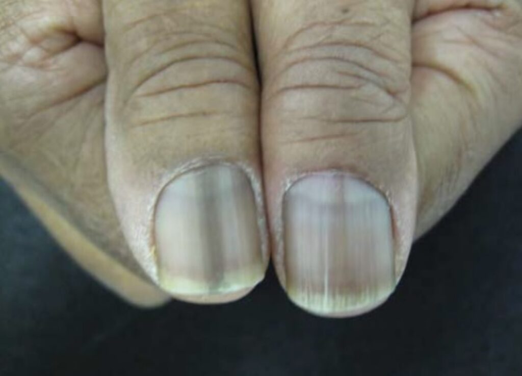Deficiências Nutricionais e Suas Manifestações nas Unhas: Um Guia Detalhado