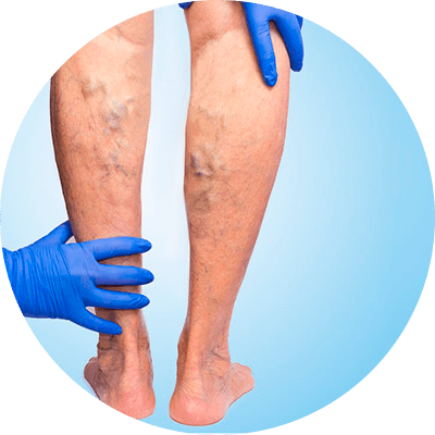 tratamento para varizes