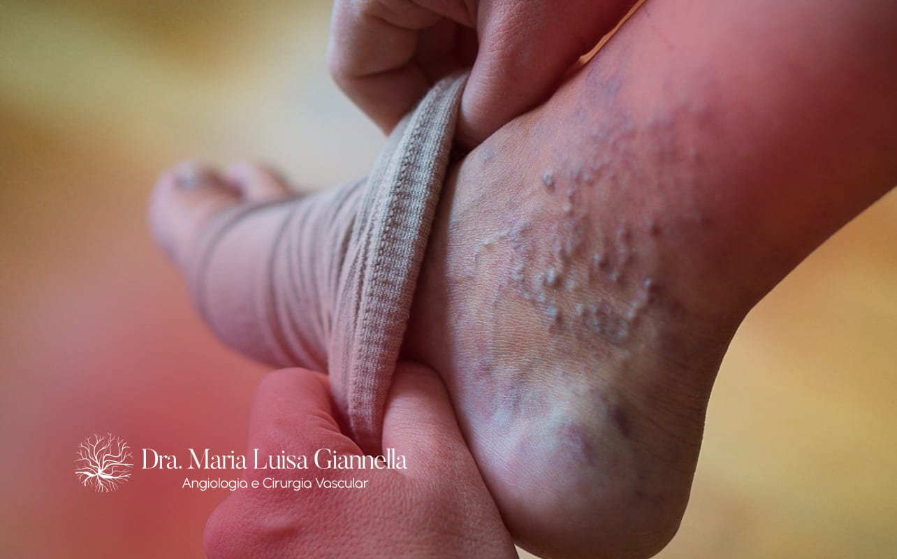 riscos de não tratar varizes