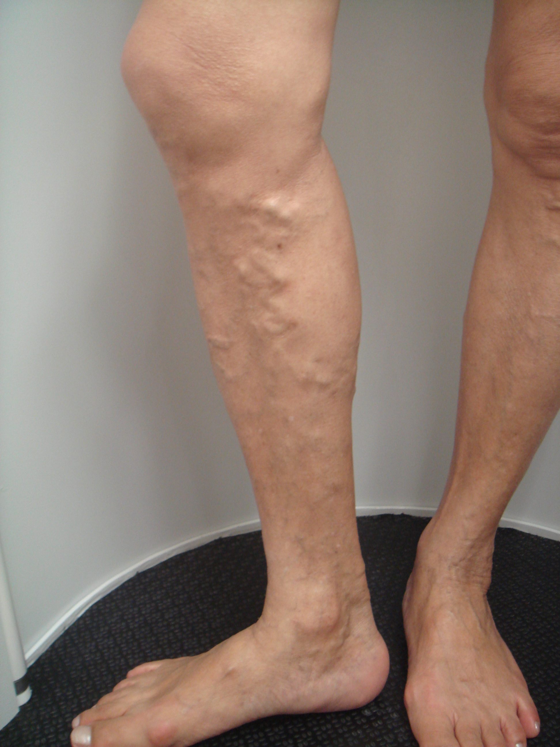 tratamento para varizes