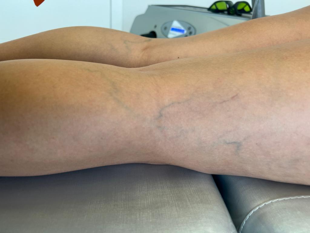 varizes e circulação sanguínea