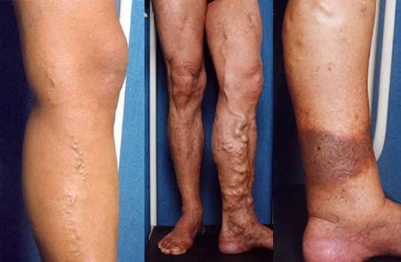 prevenção de varizes