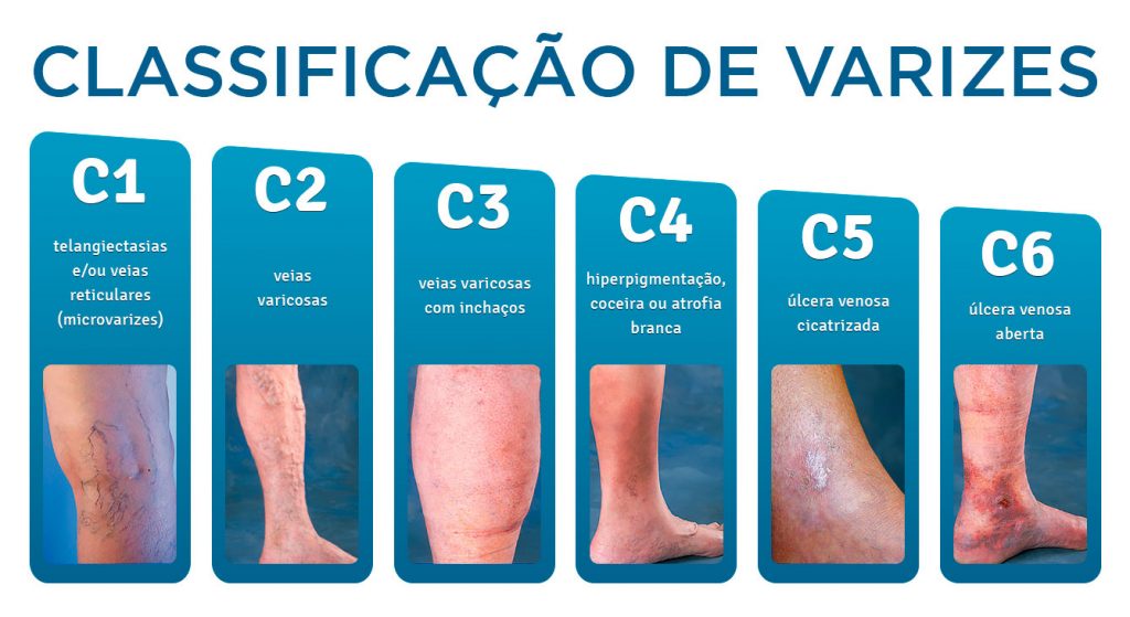 riscos de não tratar varizes